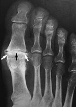 This x-ray reveals osteoarthritis in the metatarsophalangeal joint of the big toe. Joint space narrowing (black arrow) and bone spurs (white arrows) can be seen. Reproduced from Johnson TR, Steinbach LS (eds): Essentials of Musculoskeletal Imaging. Rosemont, IL American Academy of Orthopaedic Surgeons, 2004, p. 631.