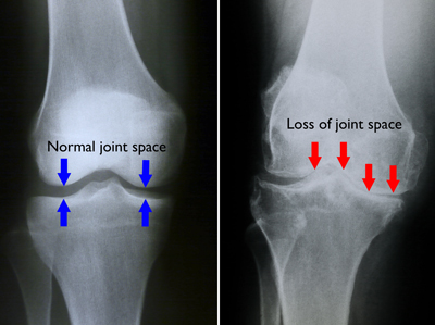 Arthritis_Doc_Exam