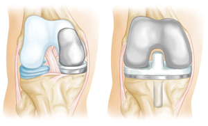 Arthritis_Treatment