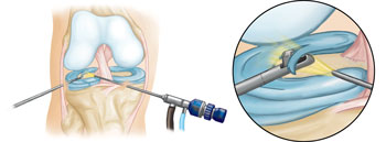 Common Knee Injuries_img10