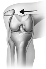 Common Knee Injuries_img3