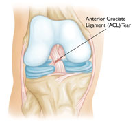 Common Knee Injuries_img4