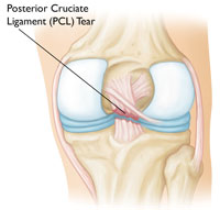 Common Knee Injuries_img5