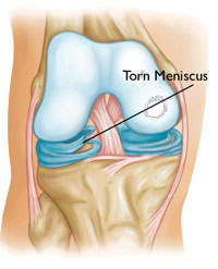 Common Knee Injuries_img7