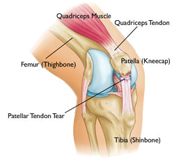 Common Knee Injuries_img8