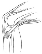 Knee Tendon Bursitis_img1