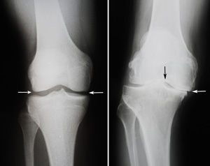 Total Knee_Orthopaedic