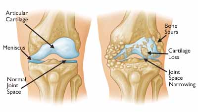 Total Knee_causes