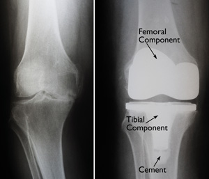 Total Knee_surgery_Img2