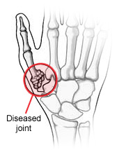 diseased-joint-img