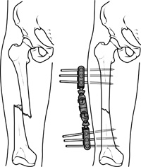 Leg with femur fracture Referenced from: Basic anatomical knowledge from WWW: http://www.anatomyatlases.org/firstaid/images/spiralfracture2.jpg