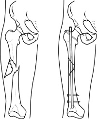 Leg with femur fracture Referenced from: Basic anatomical knowledge from WWW: http://www.anatomyatlases.org/firstaid/images/spiralfracture2.jpg