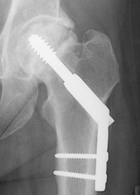 hip-fracture-img10