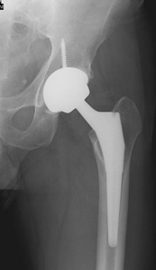 hip-fracture-img11