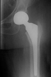 hip-fracture-img12