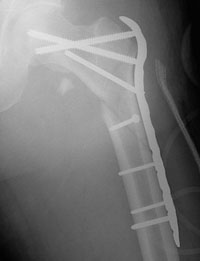 hip-fracture-img16