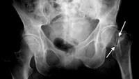 hip-fracture-img2