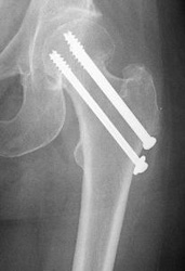 hip-fracture-img9