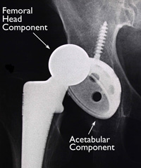 hip-implants-img13