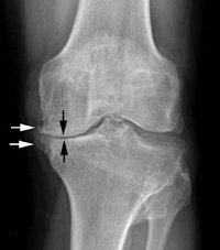 img2-osteoarthritis