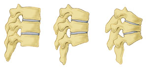 osteoporosis-img1