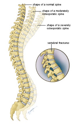 osteoporosis-img2