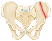 pelvis-img2