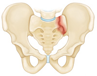 pelvis-img3