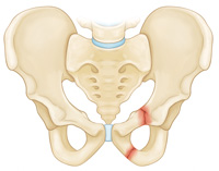 pelvis-img4