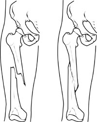 Leg with femur fracture Referenced from: Basic anatomical knowledge from WWW: http://www.anatomyatlases.org/firstaid/images/spiralfracture2.jpg