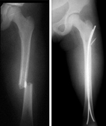 thighbone-femur-img4