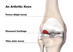 total_knee_arthritic_w